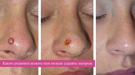 Удалили Родинку Фото — Bluemorphotours.ru