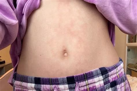 Woman left with ‘horrific' burn from hot water bottle after 'refusing ...