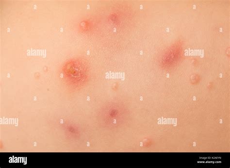 how to get rid of water warts