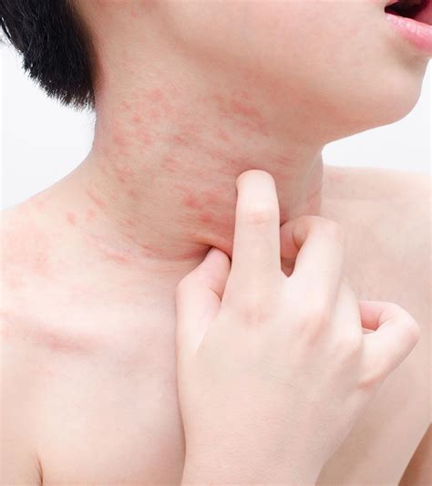 babies rashes treatment - hiccups pregnancy