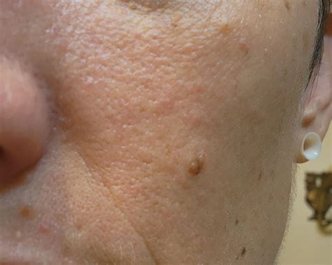 orange peel texture skin  nose