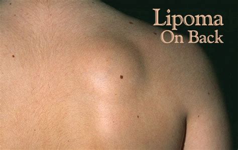 Skin Cancer Lump On Back