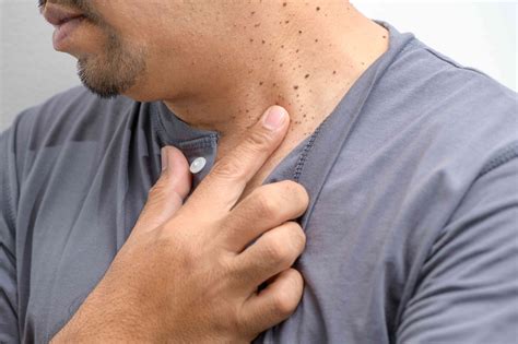 How To Identify Skin Tags and When To Remove Them