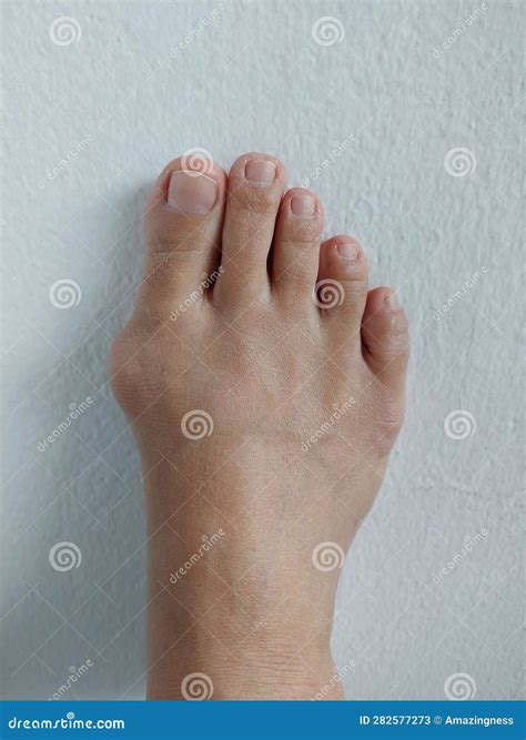 A Woman Right Foot with Hallux Valgus, Foot Bunions, Bony Bump. Stock