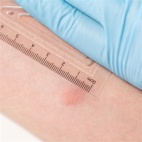 TB Skin Test & Treatment - Cedars Family Medical