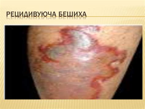 Бешиха - презентация онлайн