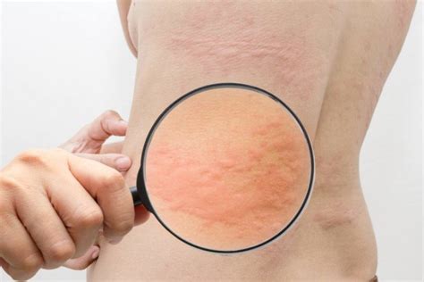 Заболевания кожи - признаки, причины, симптомы, лечение и профилактика ...