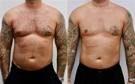 Gynecomastia Surgery | Male Breast Reduction Edinburgh