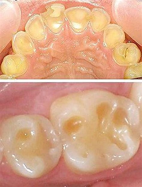 Erosive Tooth Wear From Diagnosis To Therapy Mono 11