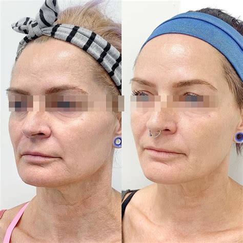 Sculptra No Rosto Antes E Depois - Sculptra Antes E Depois Veja Como Feito E Seus Resultados