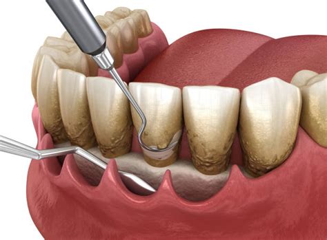 periodontal cleaning stock  pictures royalty  images