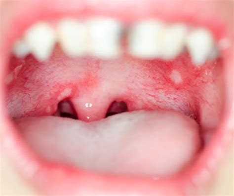 Blisters On Hard Palate at Judith Tomlin blog