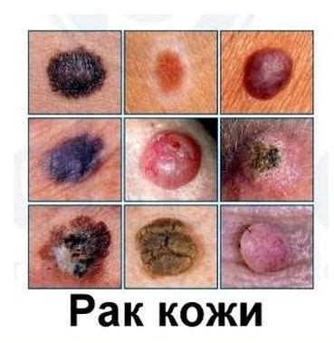 Ранняя диагностика новообразований кожи — СПб ГБУЗ Кожно ...