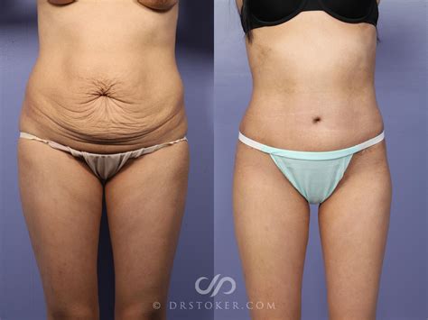 Bad Tummy Tuck Results