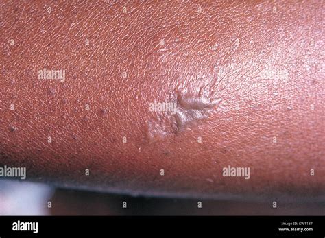 Neonatal Gonococcal Ophthalmia