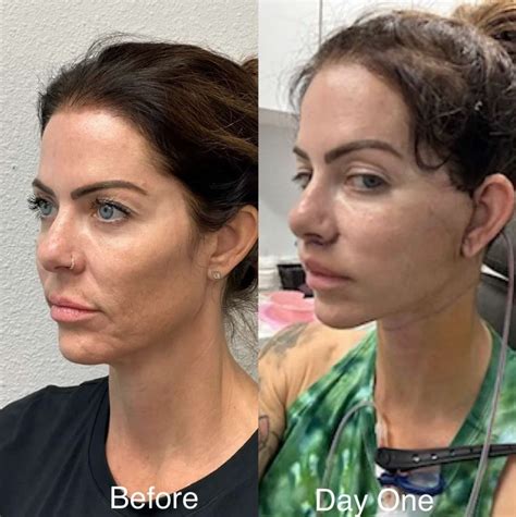 facelift recovery stages explained timeline healing