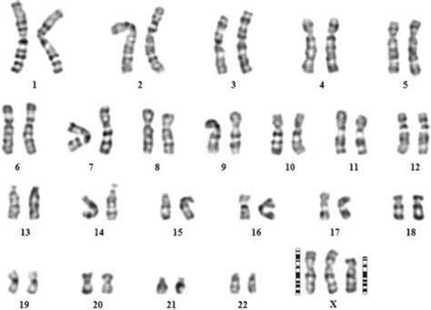 Karyotype of the triple X female showing 47,XXX del(Xp21-pter ...