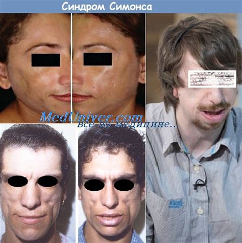 Синдром Симонса (Simons) - синонимы, авторы, клиника