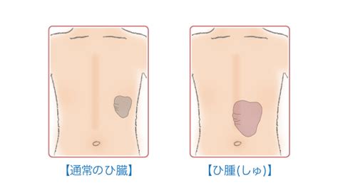 脾腫 - Splenomegaly - JapaneseClass.jp