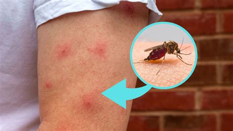 Picadas De Borrachudos O Que Fazer - Repelente natural contra os borrachudos em casa ou na praia