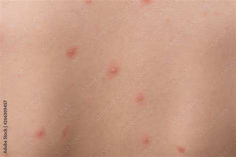 chicken pox rash  young boy bodychickenpox   infection caused