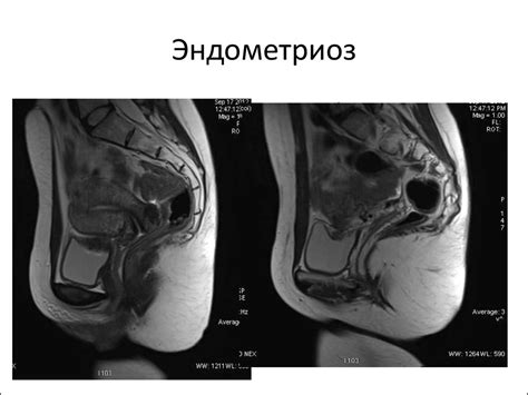 МРТ органов женского малого таза. Доброкачественные образования. Миома ...
