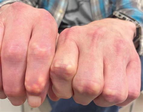 Why Do My Finger Joints Stick at Angela Debbie blog