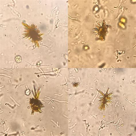 Bilirubin Crystals