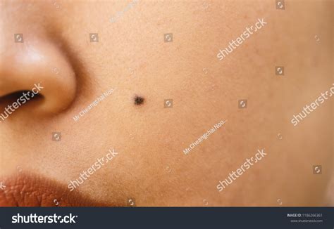 8,433 Face mole Images, Stock Photos & Vectors | Shutterstock