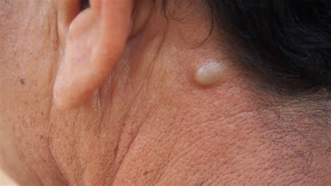 What's a Sebaceous Cyst? Signs, Treatments, and What to Expect | 1MD ...