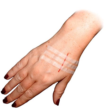 Can You Put Tegaderm On Stitches at Dean Hammock blog