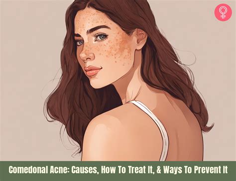 Comedonal Acne: Causes, How To Treat It, & Ways To Prevent It