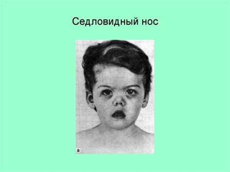 Факторы, предрасполагающие к рахиту - online presentation
