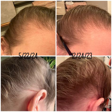 Anemia hair loss journey : r/FemaleHairLoss