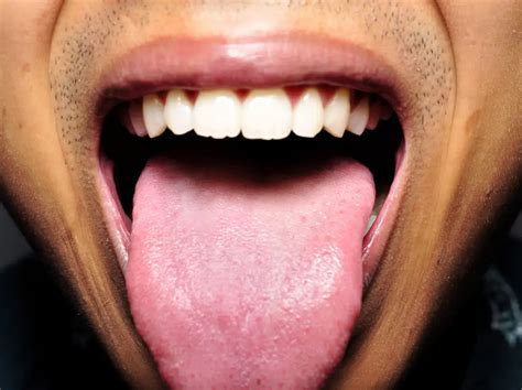 What Does A Healthy Tongue Look Like? Pictures & Issues - Acacia Ridge ...
