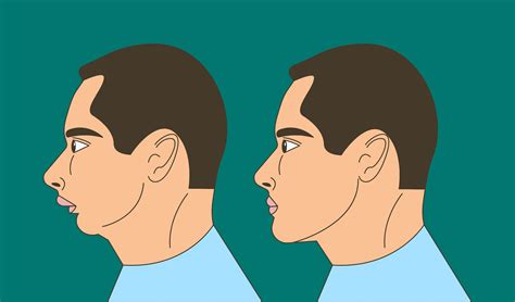 eric davis dental overbite understanding  overbite