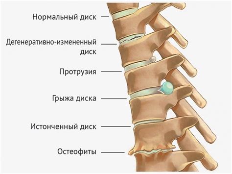 Дорсопатия шейного и поясничного отдела позвоночника: что это такое ...
