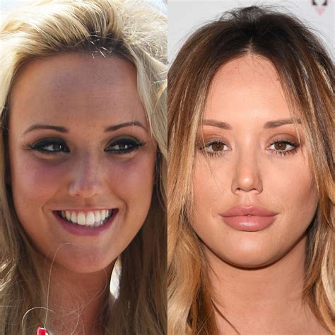 9 Celebrities Before And After Dramatic Lip Fillers | Evie Magazine