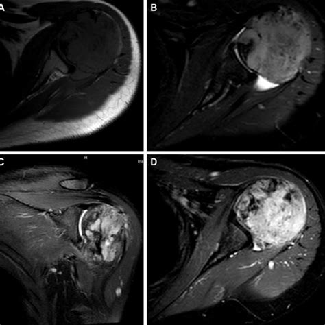 grade central osteosarcoma  proximal humerus  rare entity