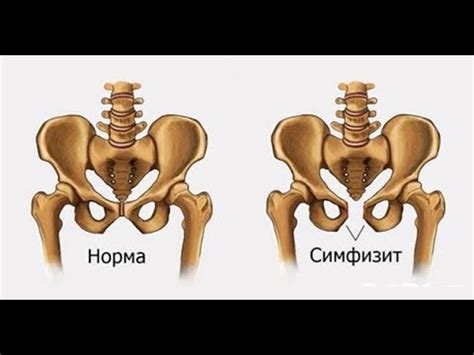 Симфизит на УЗИ беременности (29-1-19) - YouTube