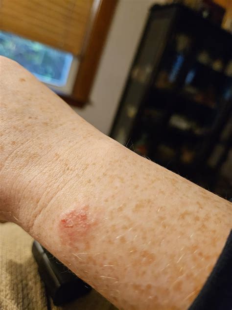 Itchy Bumps On Hands Spreading at Oliver Howell-price blog