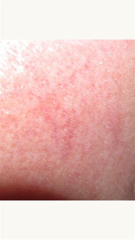 Demodex folliculitis | CLÍNICA DERMAR