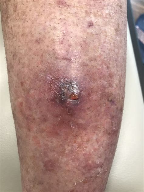 Best Wound Dressing For Pyoderma Gangrenosum at Gilbert Strothers blog