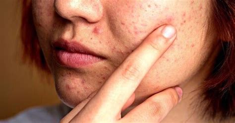 7 Benefits of Collagen for Acne Scars : r/AcneScars