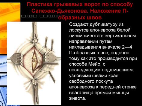 Послеоперационные вентральные грыжи - презентация онлайн