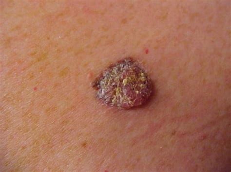 Images of melanoma | What does it look like?