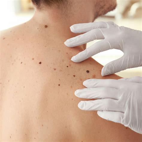 MELANOMA MONDAY - May 6, 2024 - National Today