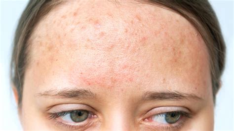 Expert Talk: What Causes Hormonal Acne and How To Deal With It | OnlyMyHealth