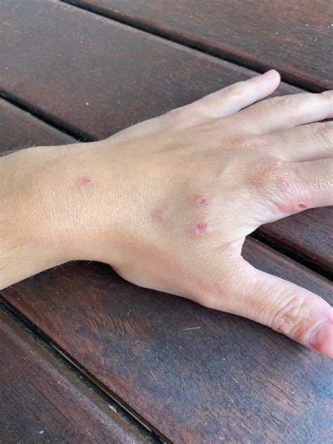 10 Signs To Distinguish Fungal Folliculitis From Its Bacterial Counterpart