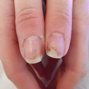 onycholysis nailknowledge